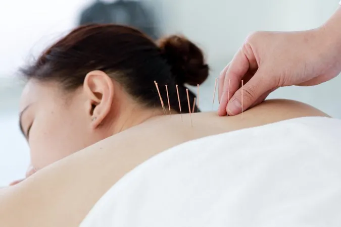 Midsection Doctor Treating Patient With Acupuncture Therapy Clinic X - Acupuncture Certification for Chiropractors study guide