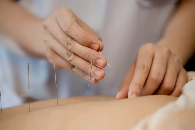 Young Woman Undergoing Acupuncture Treatment X - Acupuncture Physician study guide